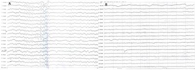 Cardiocerebral channelopathy caused by KCND3 mutation in a child: A case report